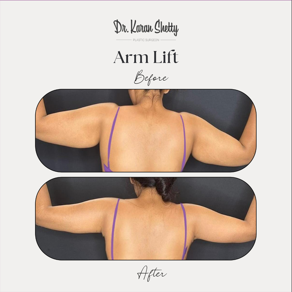 Arm Lift Before After - Dr. Karan Shetty