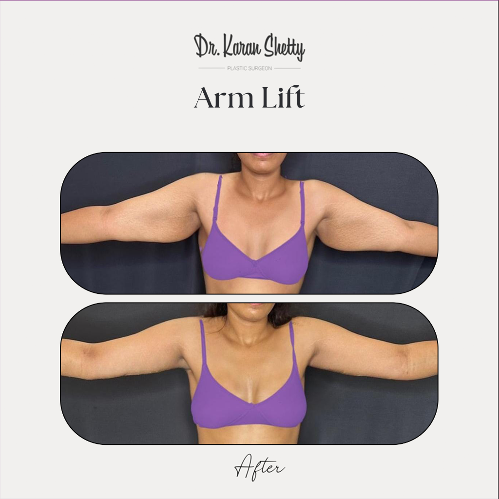 Arm Lift Results - Dr. Karan Shetty