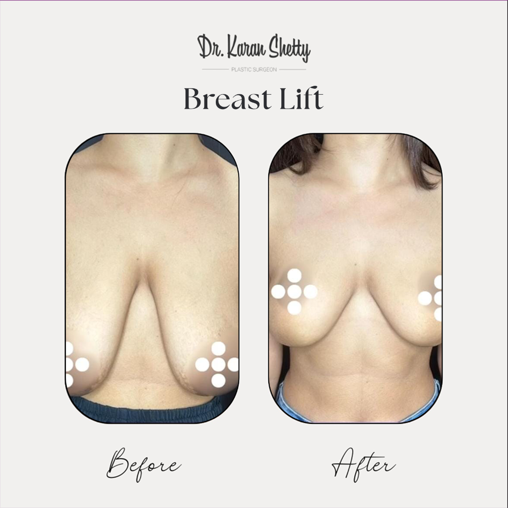 Breast Lift Before After - Dr. Karan Shetty