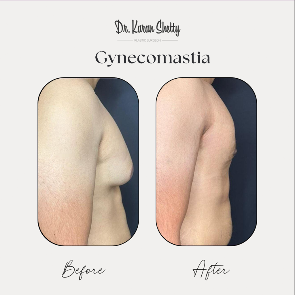 Male Chest Contouring - Dr. Karan Shetty