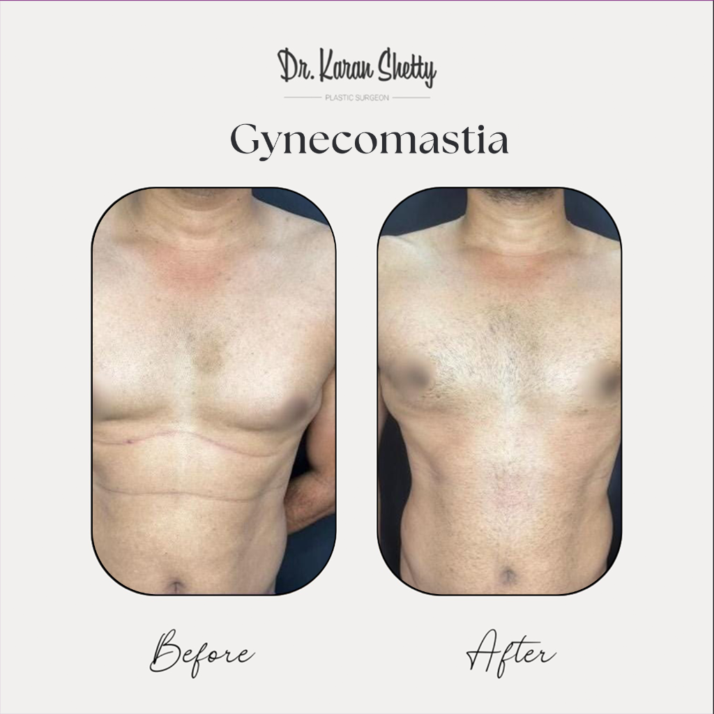 Gynecomastia Treatment - Dr. Karan Shetty