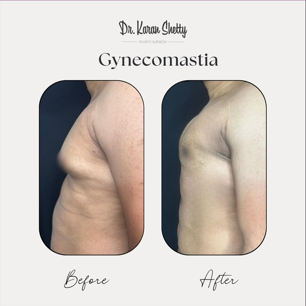 Gynecomastia Correction - Dr. Karan Shetty