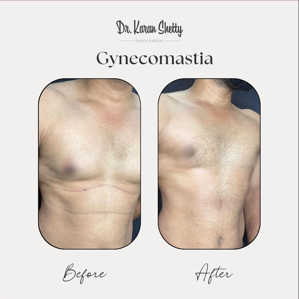 Male Breast Reduction - Dr. Karan Shetty