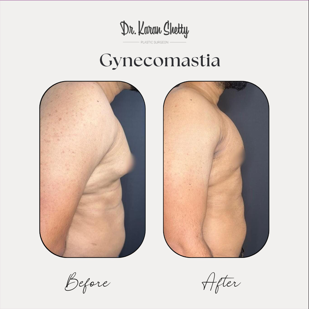 Gynecomastia Results - Dr. Karan Shetty