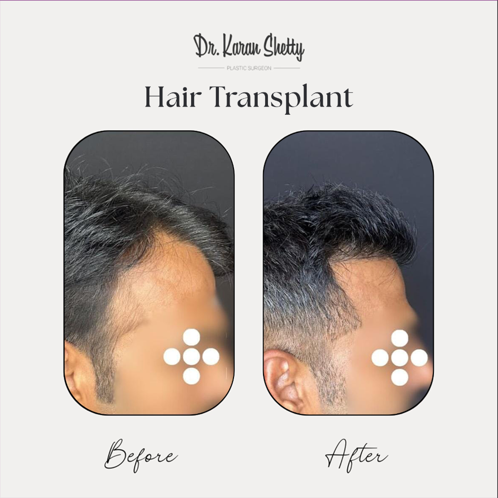 Hair Transplant Before After - Dr. Karan Shetty