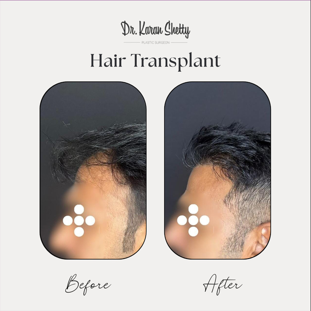 Hair Restoration Results - Dr. Karan Shetty