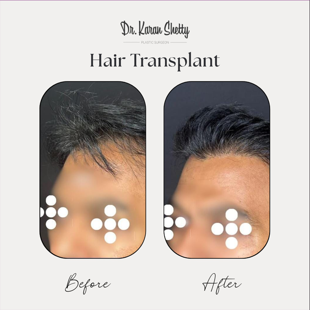 Natural Hair Regrowth - Dr. Karan Shetty