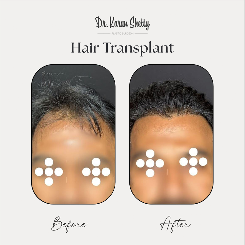 FUE Hair Transplant - Dr. Karan Shetty