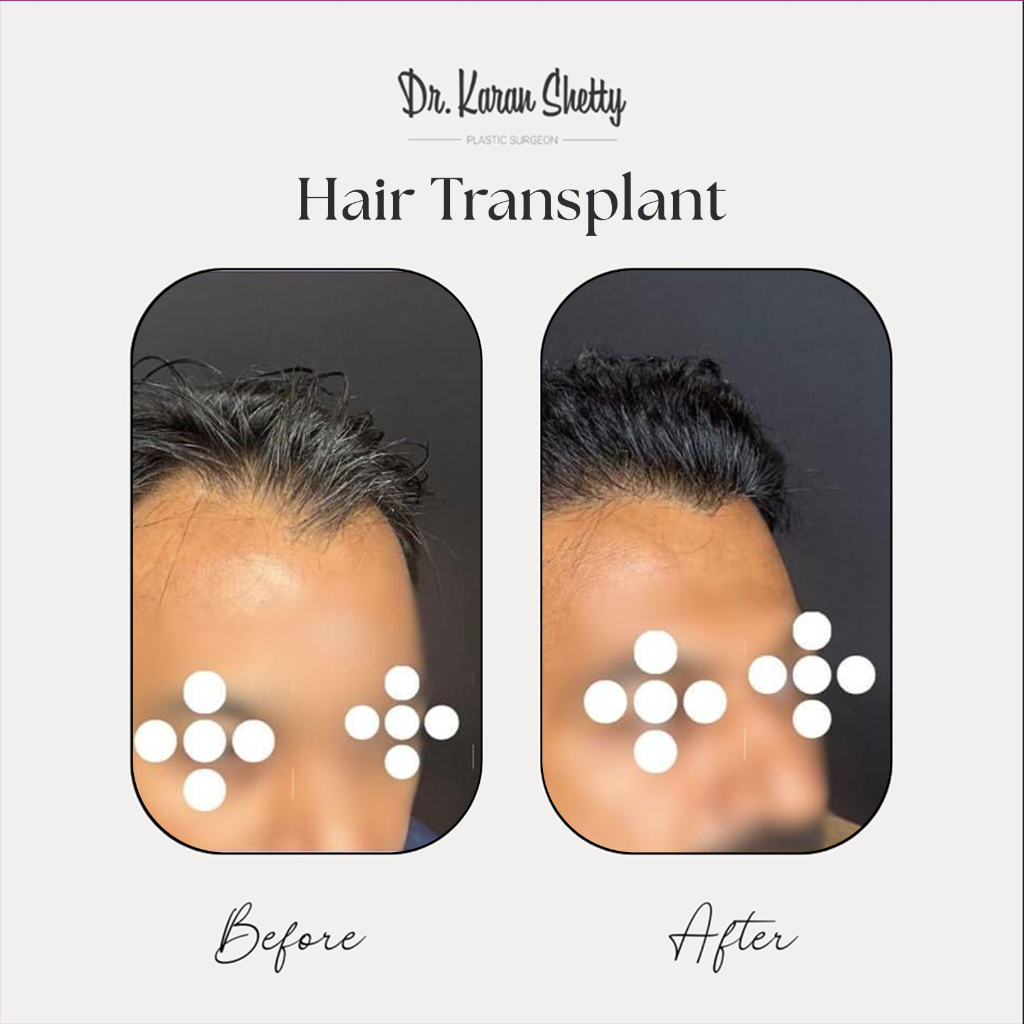 Hair Density Results - Dr. Karan Shetty