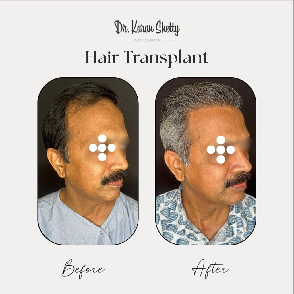 Hairline Restoration - Dr. Karan Shetty