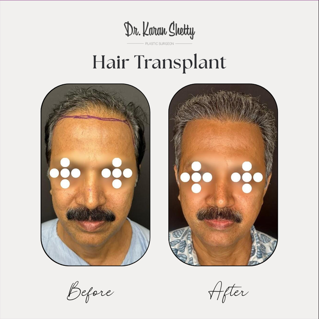 Hair Growth Results - Dr. Karan Shetty
