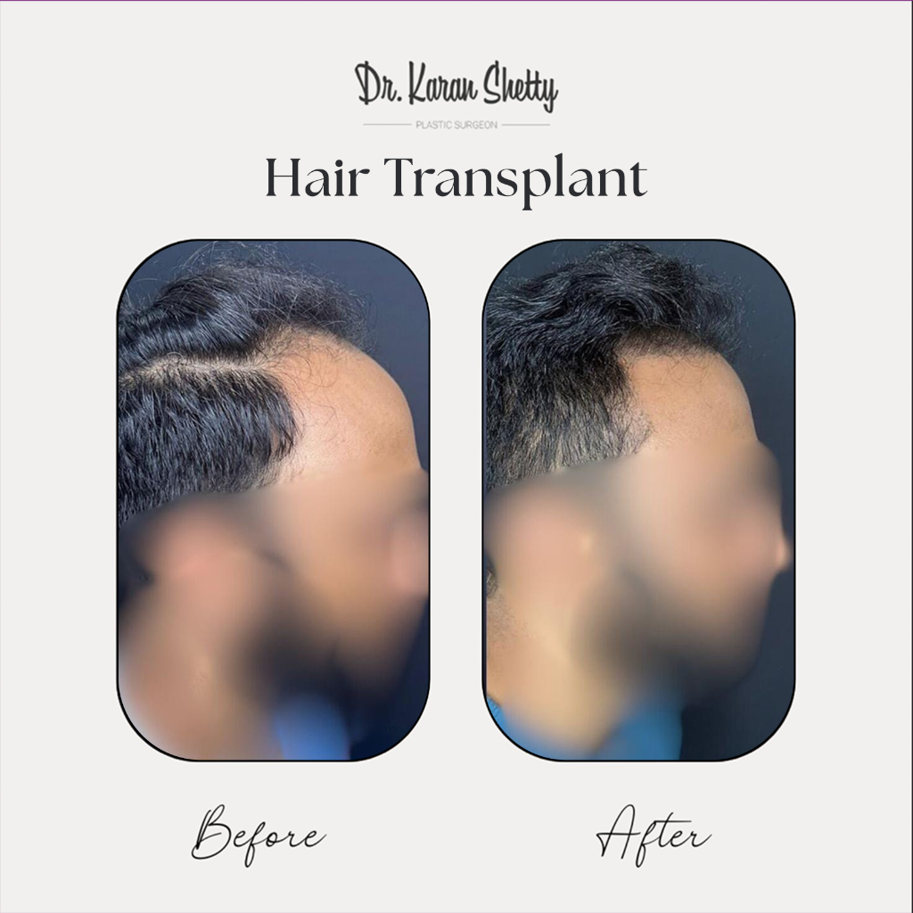 Permanent Hair Solution - Dr. Karan Shetty