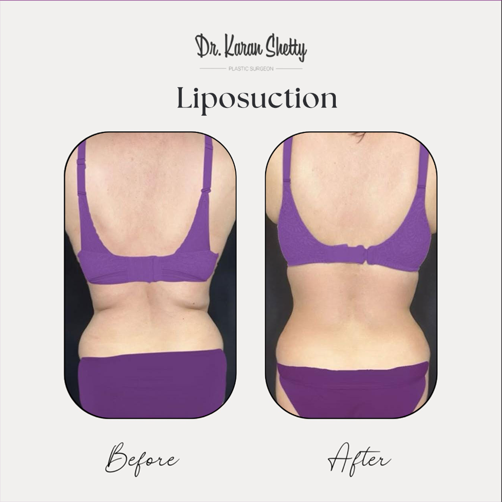 Body Contouring Results