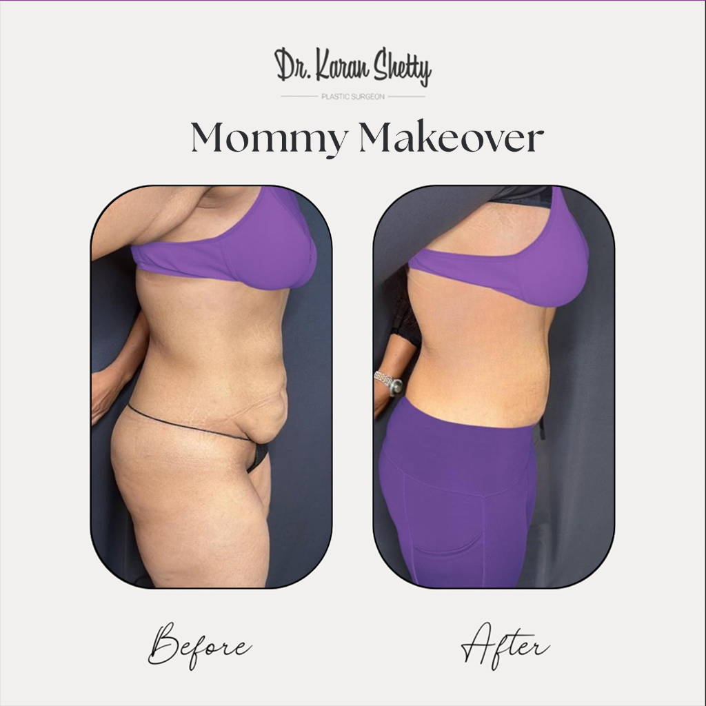 Mommy Makeover Before After - Dr. Karan Shetty