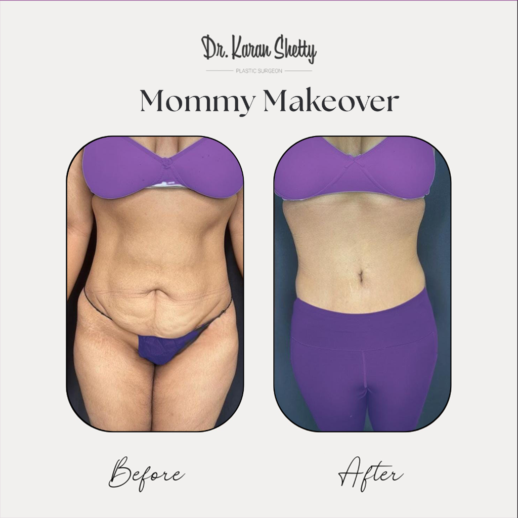 Post Pregnancy Body Transformation - Dr. Karan Shetty